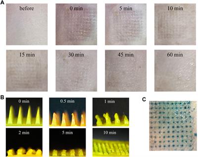 Glycyrrhizic acid modified Poria cocos polyscaccharide carbon dots dissolving microneedles for methotrexate delivery to treat rheumatoid arthritis